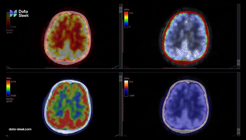 Brain Imaging: Advanced imaging techniques